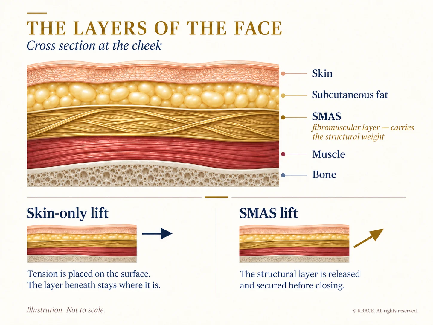 Cross section of the facial layers showing skin, subcutaneous fat, the SMAS, muscle, and bone